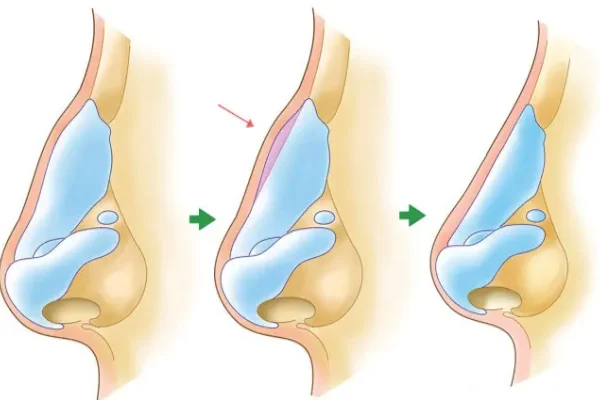 برگشت بینی بعد از جراحی قوز بینی