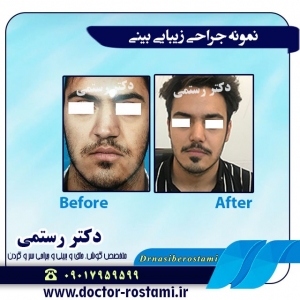 نمونه جراحی بینی