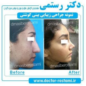 نمونه جراحی بینی گوشتی