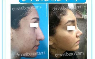 از بین بردن سریع کبودی بعد از عمل بینی