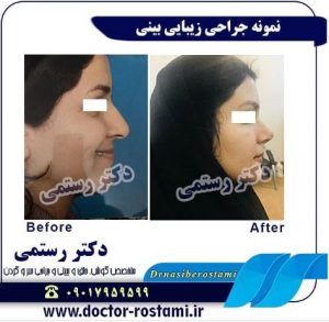 نمونه جراحی زیبایی بینی با نوع استخوانی