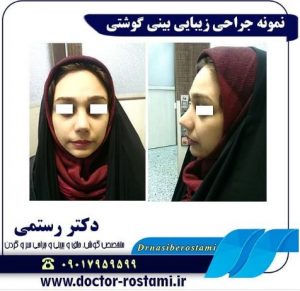 جراحی زیبایی بینی گوشتی