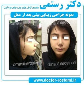 نمونه بینی بعد از جراحی