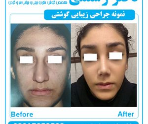 جراحی بینی و شیردهی