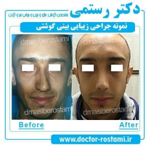 جراحی بینی در آقایان