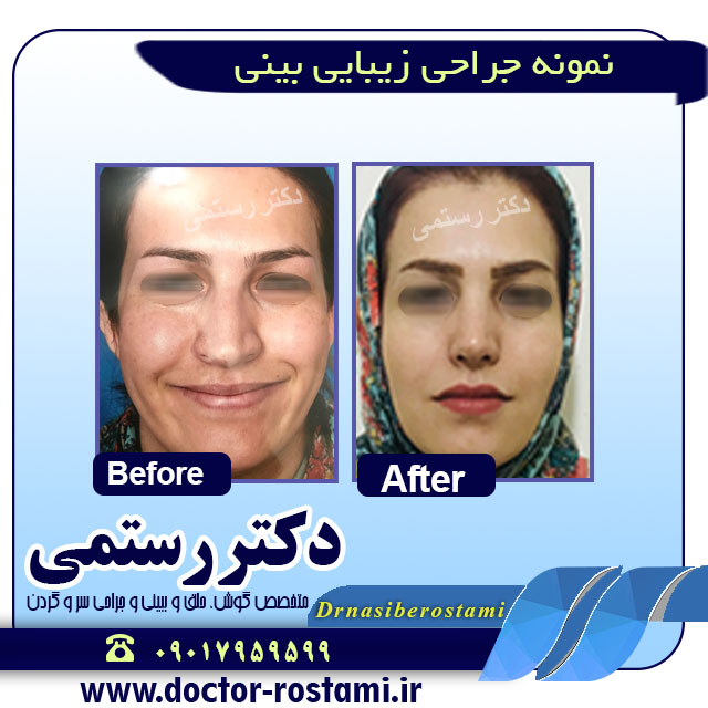 نمونه جراحی بینی دکتر رستمی