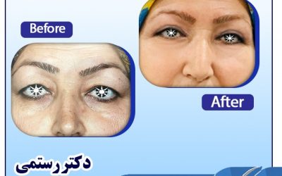 جراحی افتادگی پلک