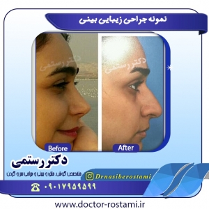 نمونه جراحی زیبایی بینی