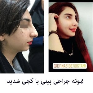 جراحی بینی کج توسط دکتر رستمی