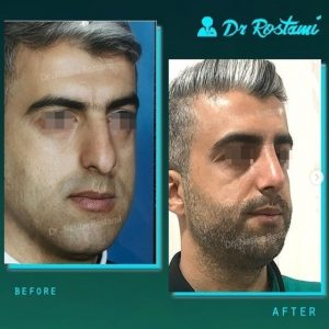 نمونه جراحی بینی استخوانی دکتر نصیبه رستمی