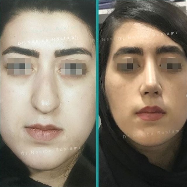 نمونه رضایتمندی از جراحی بینی طبیعی دکتر نصیبه رستمی