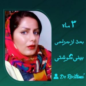 نمونه مراجعه کننده از جراحی زیبایی بینی دکتر نصیبه رستمی