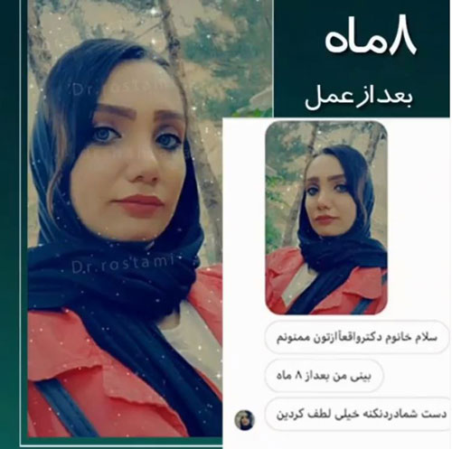 نمونه رضایتمندی جراحی زیبایی بینی دکتر رستمی