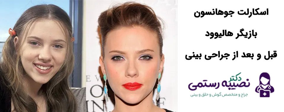 جراحی بینی اسکارلت جوهانسون