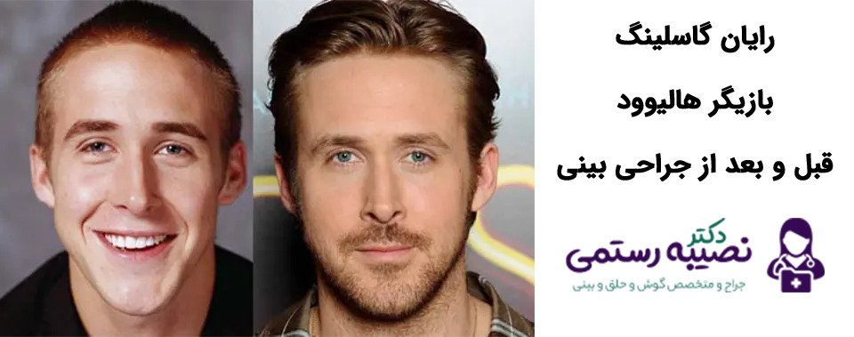 جراحی بینی رایان گاسلینگ
