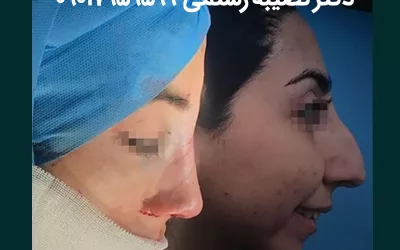 عمل بینی زنانه نزد بهترین جراح بینی خانم در تهران