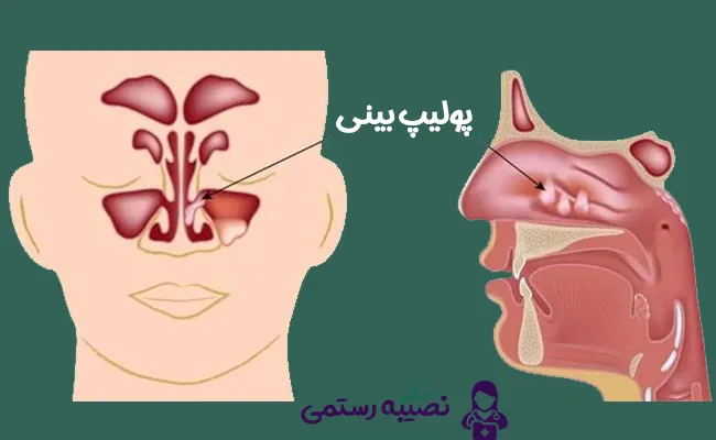 پولیپ بینی