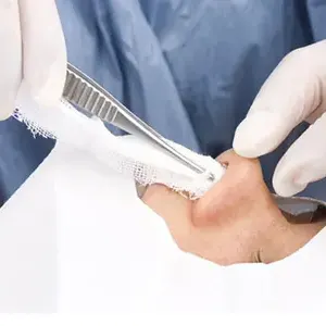 جراحی بینی بدون تامپون